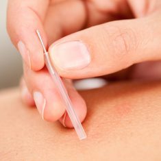 dryneedling dryneedling